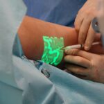 leczenie zylakow przebieg